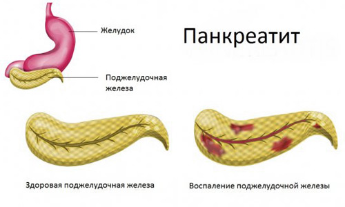 боли при панкреатите