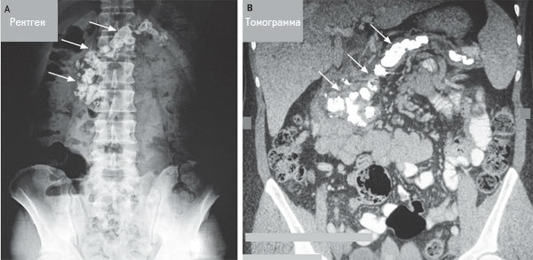 Хронический кальцифицирующий панкреатит (камни в поджелудочной)
