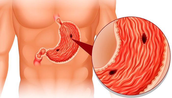 Прободения тела желудка Прободения тела желудка