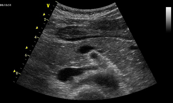 Волнистые контуры поджелудочной железы что это