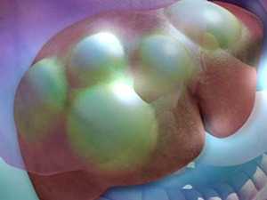 Эхинококк в печени