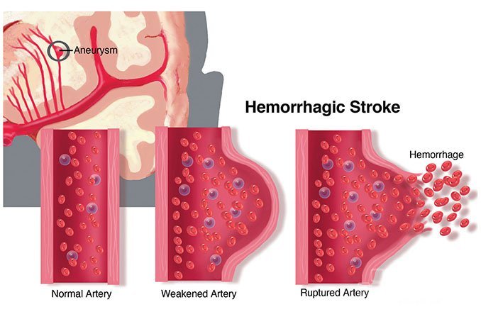 Методы лечения геморрагического синдрома