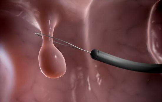 Удаление полипа эндоскопом