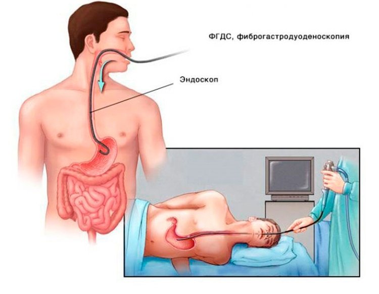 Гастроскопия