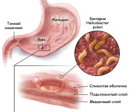 гастрит желудка