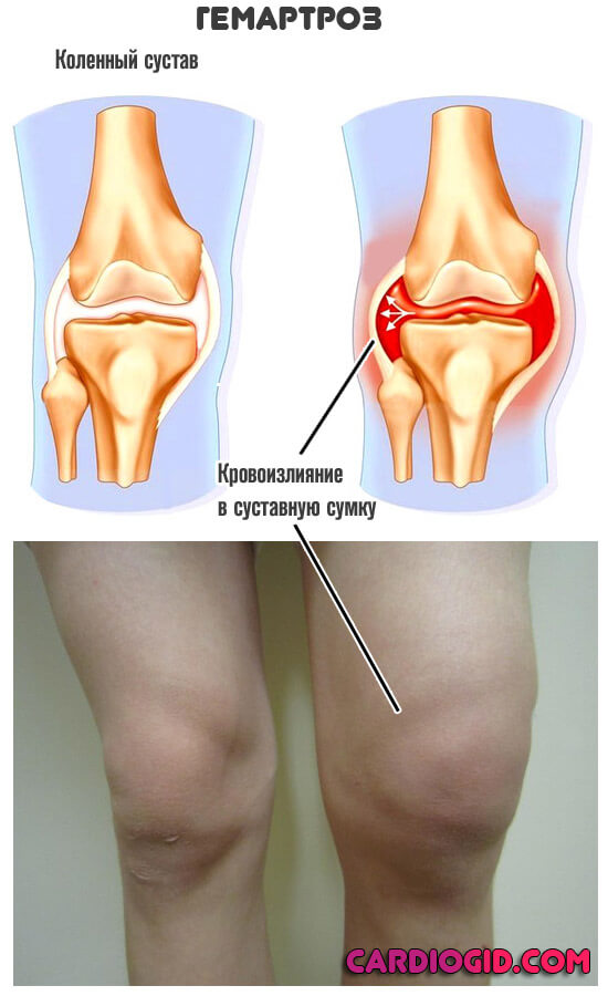 гемартроз