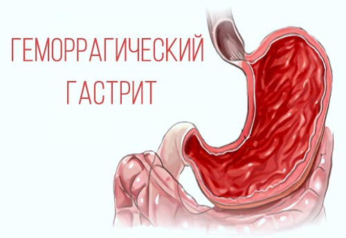 геморрагический гастрит