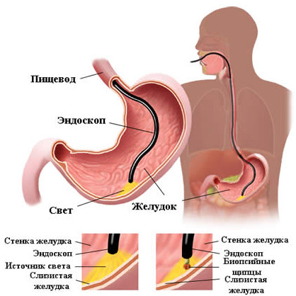 Эндоскопическая биопсия слизистой желудка