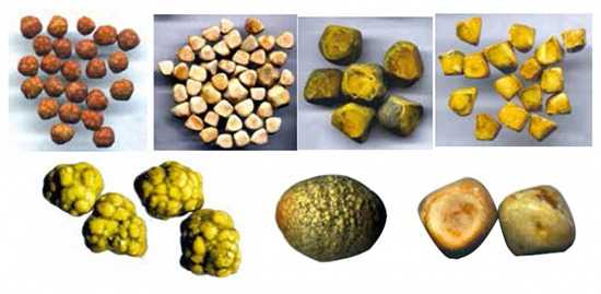 Холестериновые камни