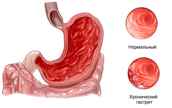 хронический гастрит