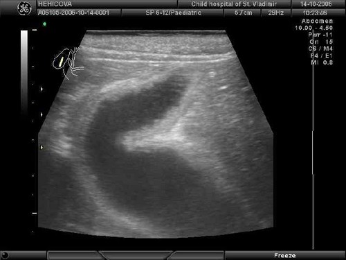 Реактивные изменения ПЖ