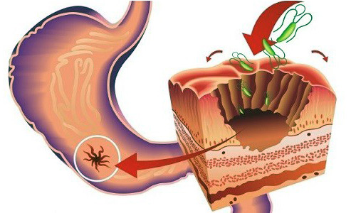 язва и боль