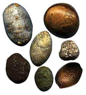 Камни смешанного типа в желчном пузыре