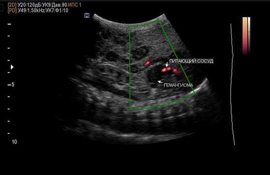 Кавернозная гемангиома печени на УЗИ