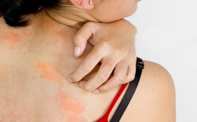 Одним из побочных эффектов является аллергическая реакция