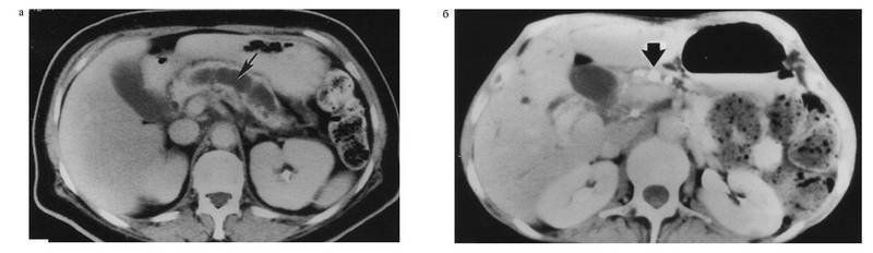 Компьютерная томограмма у больного хроническим панкреатитом Компьютерная томограмма у больного хроническим панкреатитом