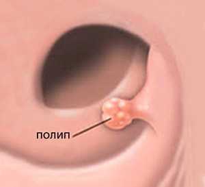 Полип на ножке в желчном пузыре