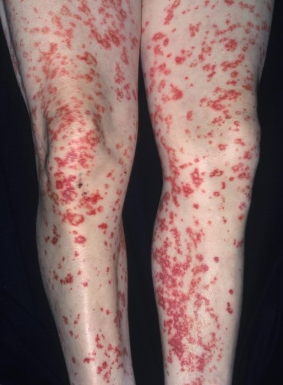 сыпь на ногах