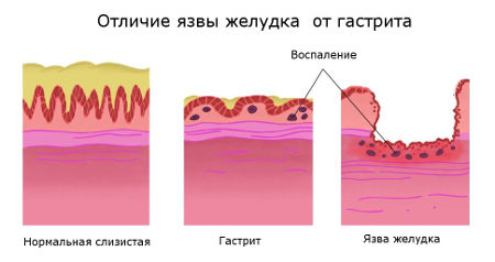 Чем отличается гастрит от язвы желудка Чем отличается язва от гастрита
