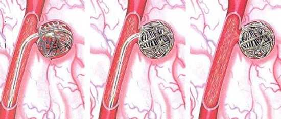 Стадии развития гемангиомы