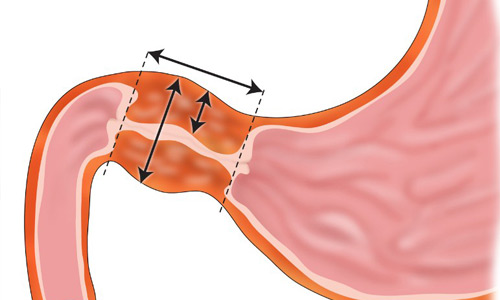 стеноз привратника