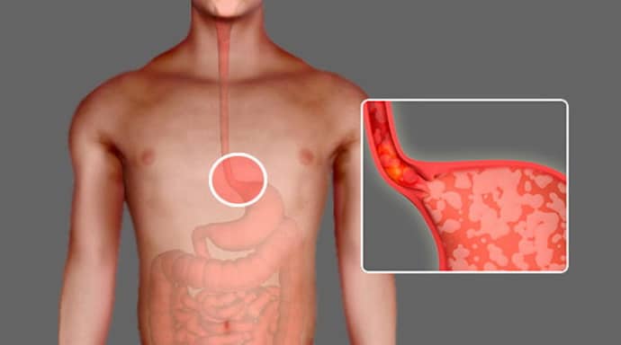Изжога при гастрите