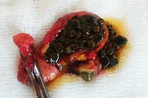 Удаленный желчный пузырь с камнями