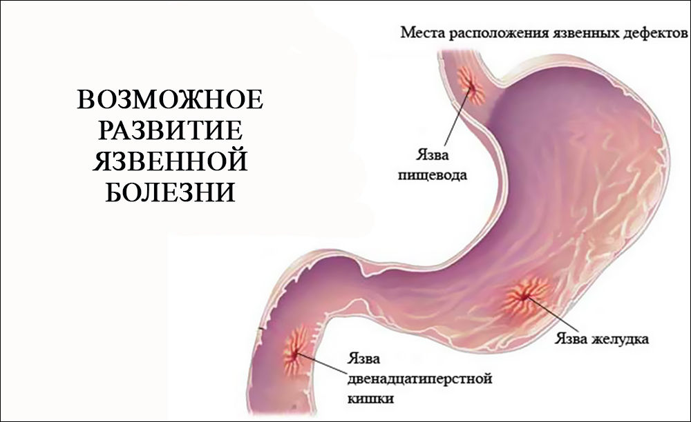 Возможное развитие язвенной болезни Возможное развитие язвенной болезни