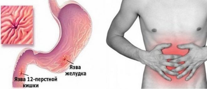 Язва 12-перстной кишки - симптомы и лечение