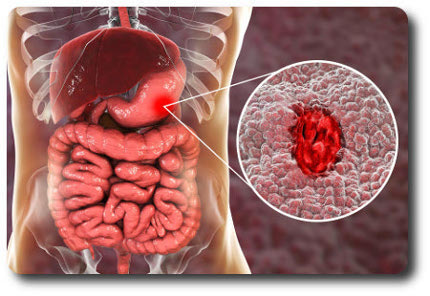 Причины язвенной болезни Язвенная болезнь желудка - что это такое