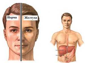Желтуха при повышении билирубина